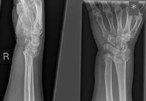 Right distal radius fracture