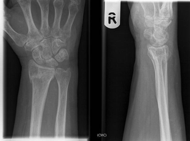 Anatomically healed fracture in patient treated with PolyArmour Non-invasive Wrist fixator who has an excellent functional result. 